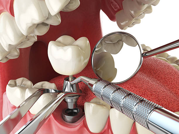 Best Emergency Tooth Extraction in Clover Creek, WA